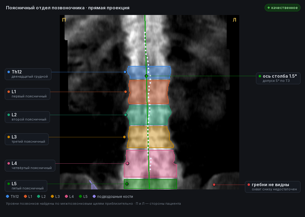 атлас: поясничный отдел